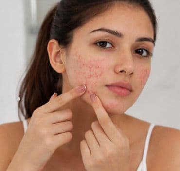 Acne Treatment in Indiranagar