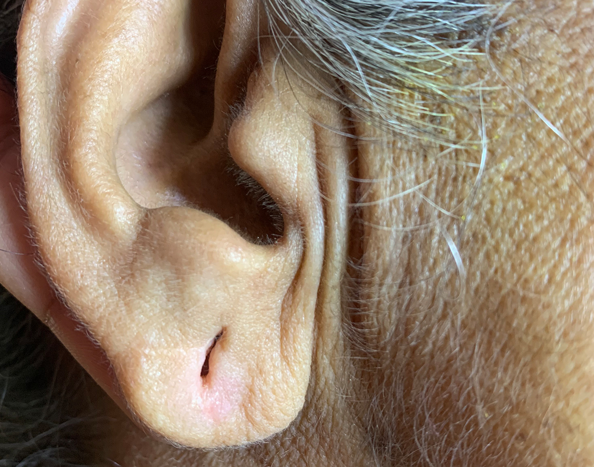 Earlobe Repair Treatment Skinessence