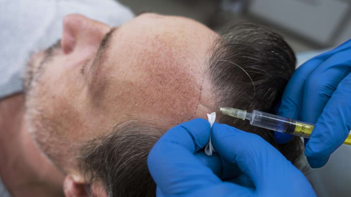 Scalp Micropigmentation (SMP)