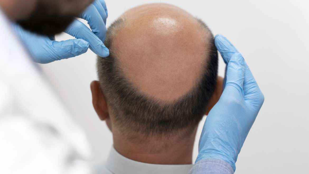 Hair Transplantaion Treatment