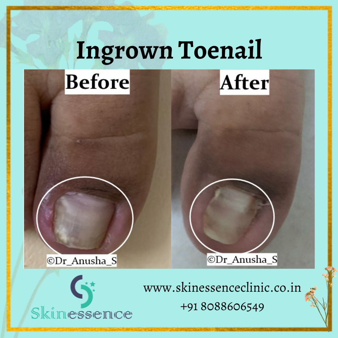 Retrospective Evaluation of Conservative Treatment for 140 Ingrown Toenails  with a Novel Taping Procedure | HTML | Acta Dermato-Venereologica