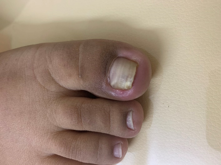 CO2 Laser Matricectomy for the Treatment of Pincer Nail Deformity: A  Retrospective Cohort Study - JDDonline - Journal of Drugs in Dermatology