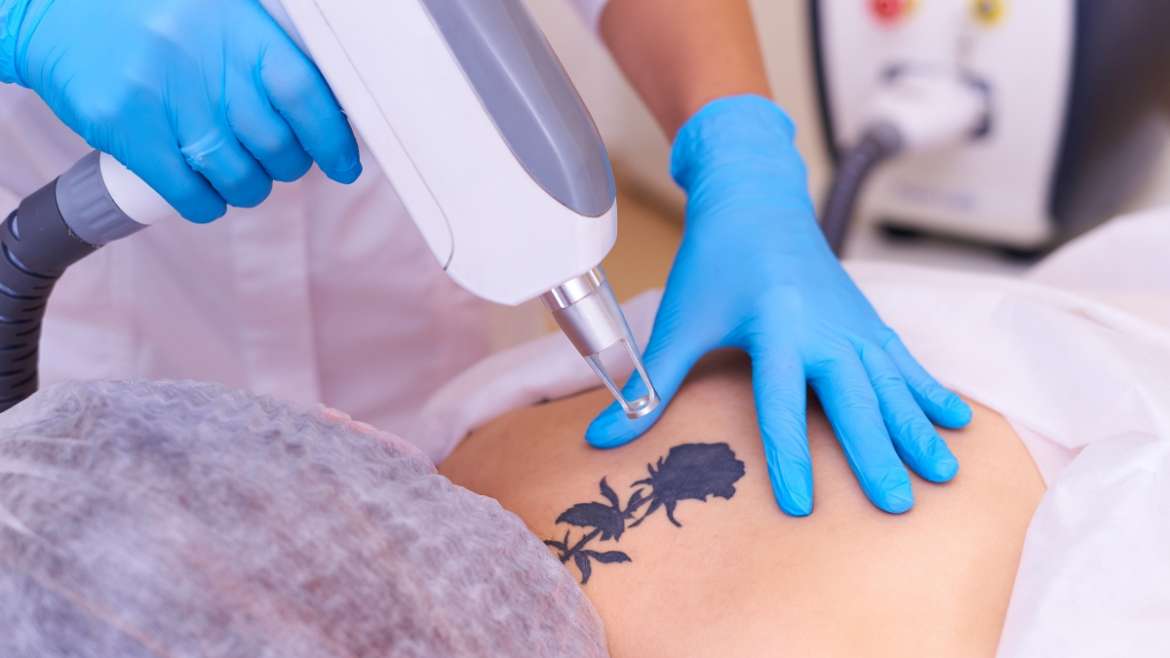 Pigmentation Treatment / Tattoo Removal